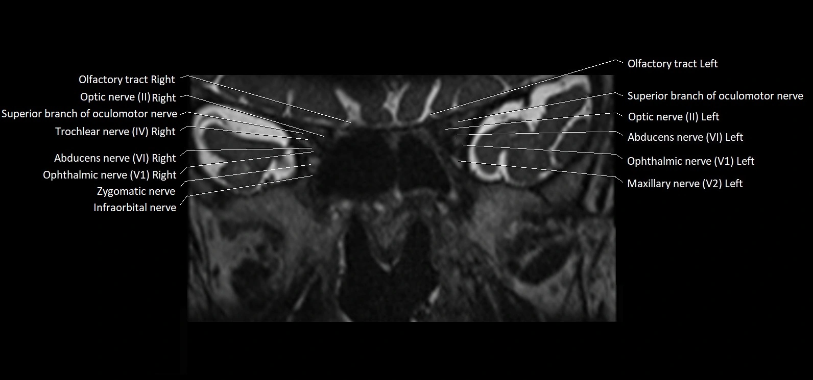 Cranial nerve cross sectional anatomy coronal 3T MRI image 17.webp